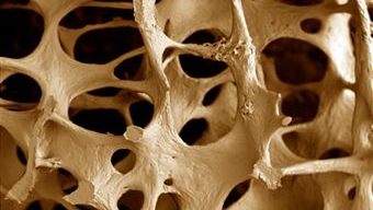 Osteoporose: testes clínicos revelam eficácia no uso de um chip para tratamento do problema