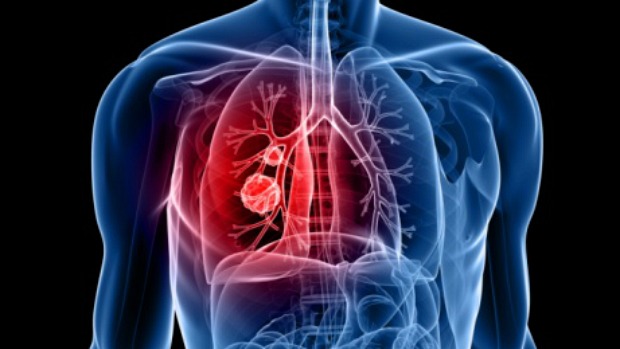 Entre todos os tipos de câncer, o de pulmão é o responsável pelo maior número de mortes.