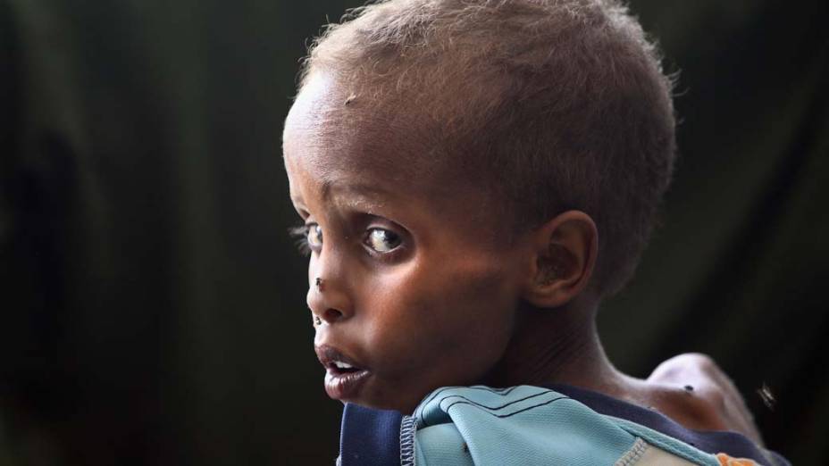 Criança desnutrida aguarda atendimento médico no hospital Banadir, em Mogadíscio, Somália