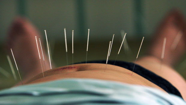 Paciente se submete a acupuntura