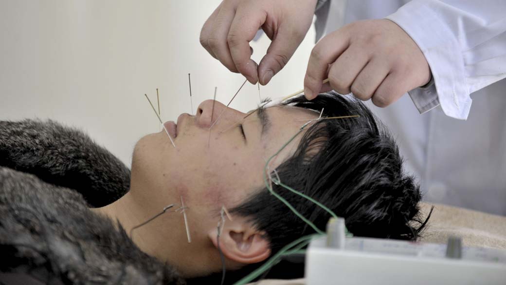 Tratamento de acupuntura em Shenyang, China. A prática foi incorporada hoje pela UNESCO à lista do Patrimônio Cultural da Humanidade