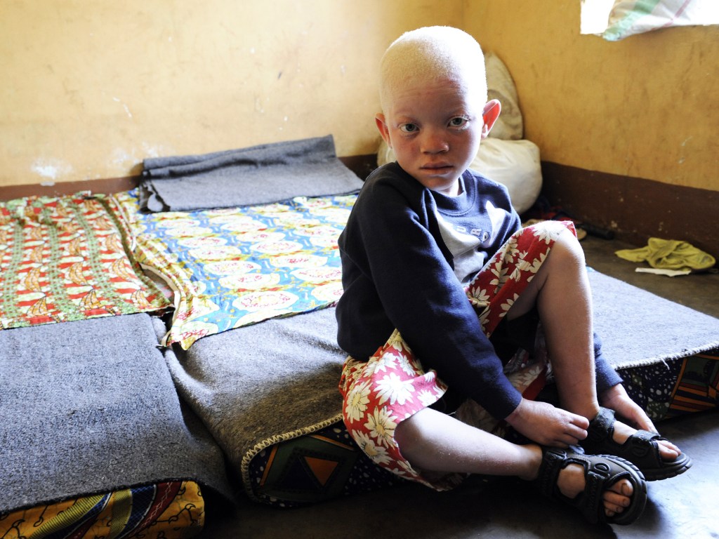 Criança albina no Burundi