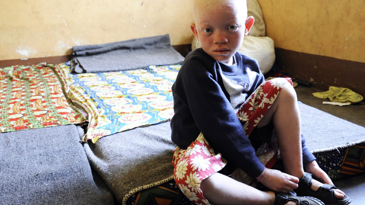 Criança albina no Burundi