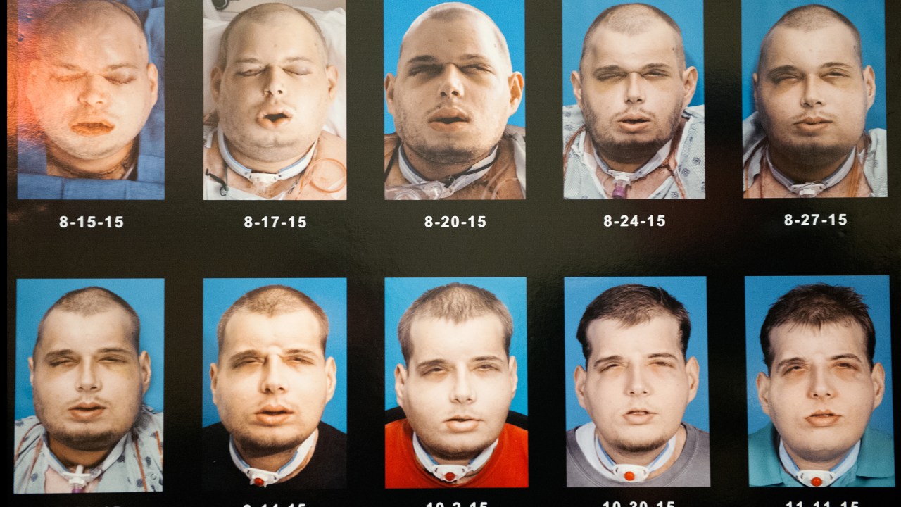 A sequência de imagens mostra a recuperação de Hardison durante os três meses após o transplante de face realizado em agosto, nos Estados Unidos