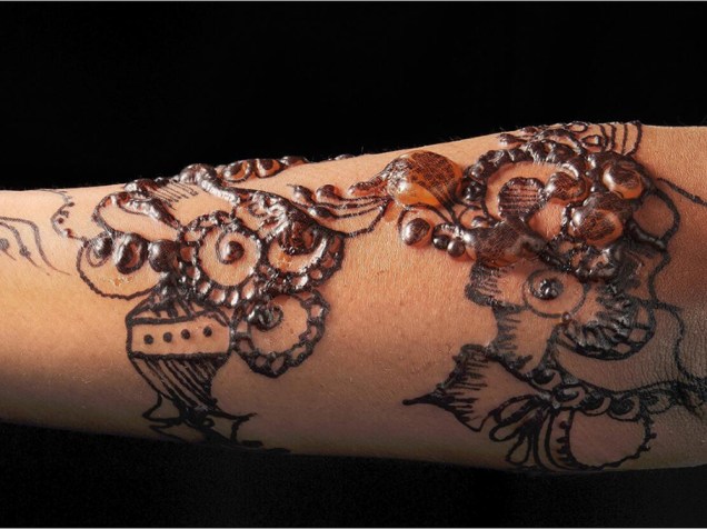 <p>A imagem, tirada por Nicola Kelley, da Cardiff and Vale University Hospital NHS Trust, no Reino Unido, mostra o braço de uma jovem com bolhas ocasionadas pela reação alérgica à pintura com henna. Produtos químicos adicionados à tinta podem causar queimaduras</p>