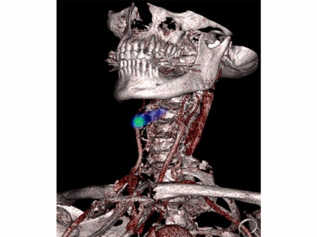 <p>Na representação em verde é possível identificar um bloqueio na artéria que leva sangue ao cérebro, passando pelo pescoço. A imagem foi tirada por Nicholas Evans, da Universidade de Cambridge, no Reino Unido</p>