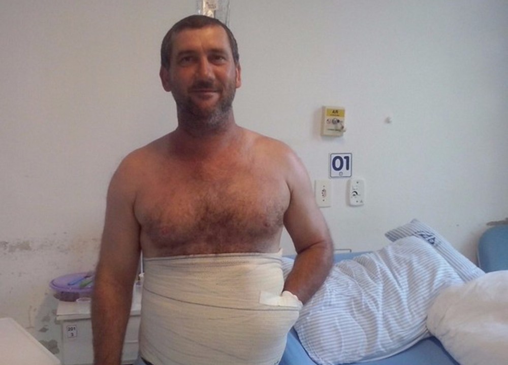 O auxiliar de produção Carlos Mariotti teve a mão implantada no abdômen para evitar a amputação do membro, após sofrer um acidente de trabalho em Santa Catarina