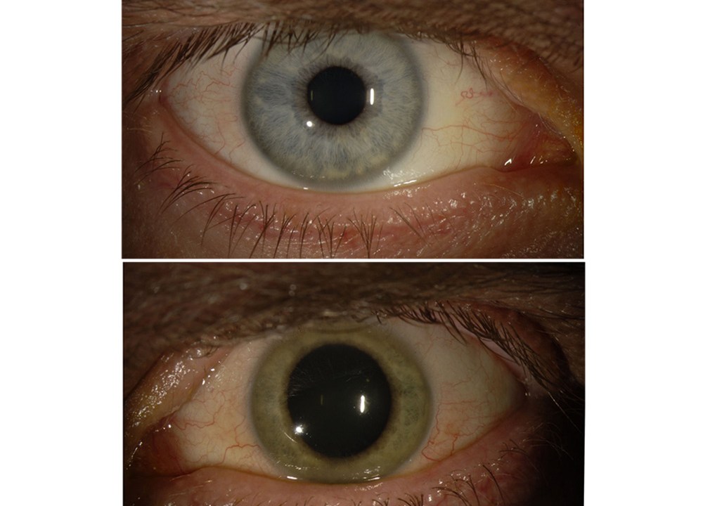 A cor do olho de Ian Crozier mudou de azul para verde após infecção causada pelo vírus ebola. Segundo os médicos, o organismo foi encontrado no olho do paciente meses após ele ter sido curado da doença