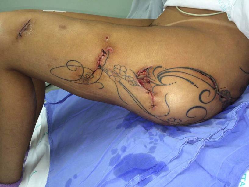 Ferimentos na perna de Andressa Urach, que foi submetida a uma drenagem cirúrgica por causa de uma infecção, decorrência de complicações de uma aplicação de hidrogel