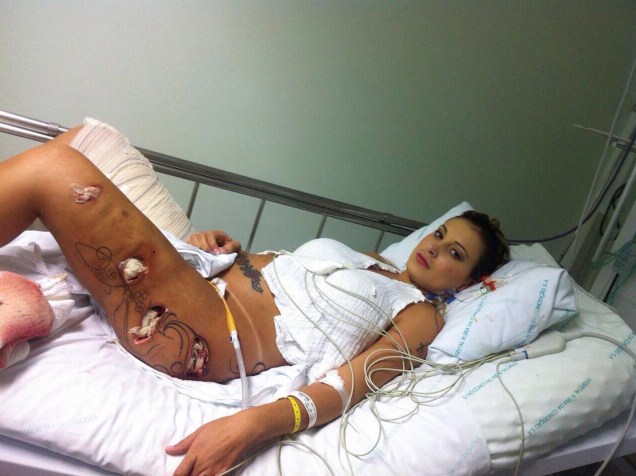 Andressa Urach foi submetida a uma drenagem cirúrgica por causa de uma infecção, decorrência de complicações de uma aplicação de hidrogel