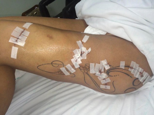 Ferimentos na perna de Andressa Urach, que foi submetida a uma drenagem cirúrgica por causa de uma infecção, decorrência de complicações de uma aplicação de hidrogel