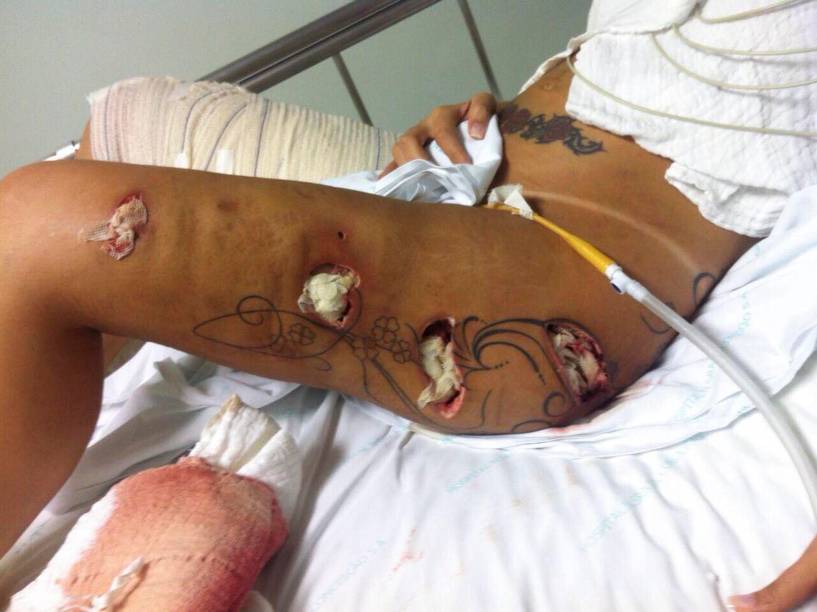 Ferimentos na perna de Andressa Urach, que foi submetida a uma drenagem cirúrgica por causa de uma infecção, decorrência de complicações de uma aplicação de hidrogel