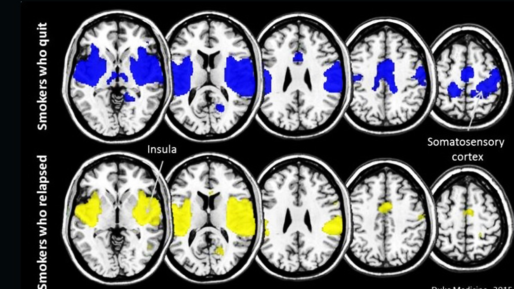 A ínsula (em amarelo) e o sistema somatossensorial (em azul) foram as regiões do cérebro que se mostraram mais ativadas entre os que conseguiram parar de fumar