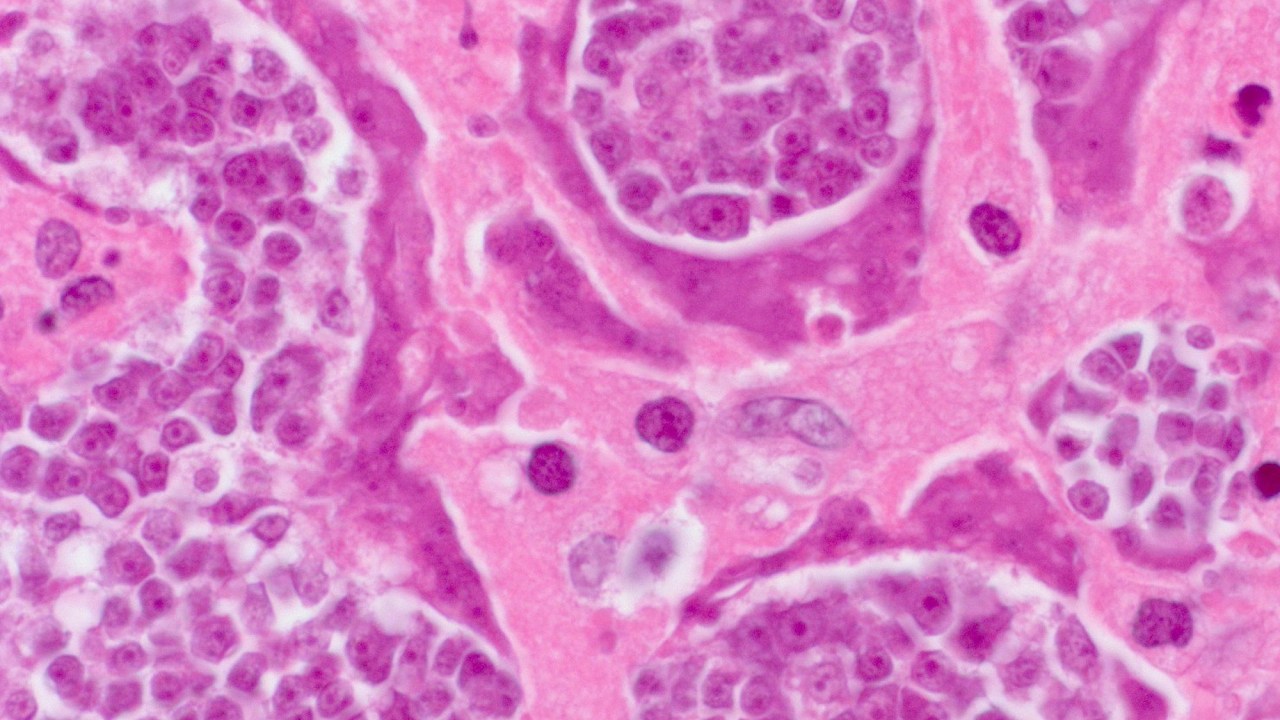 As células malignas, diagnosticas como câncer, encontradas no corpo de um colombiano continham DNA de um parasita conhecido como tênia anã, que infecta o trato gastrointestinal