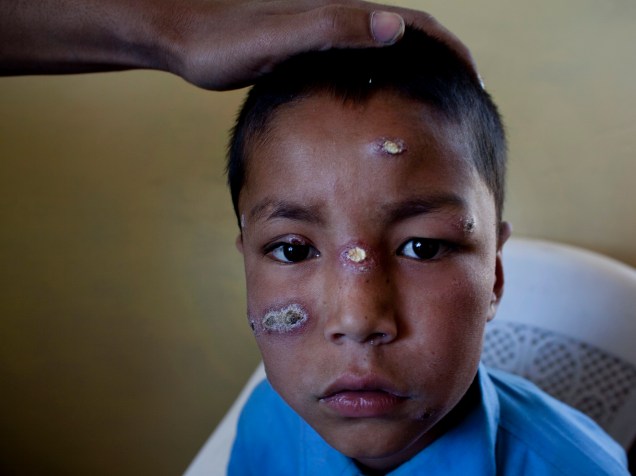 Criança recebe tratamento para Leishmaniose, doença transmitida pelo "mosquito-palha", no Afeganistão