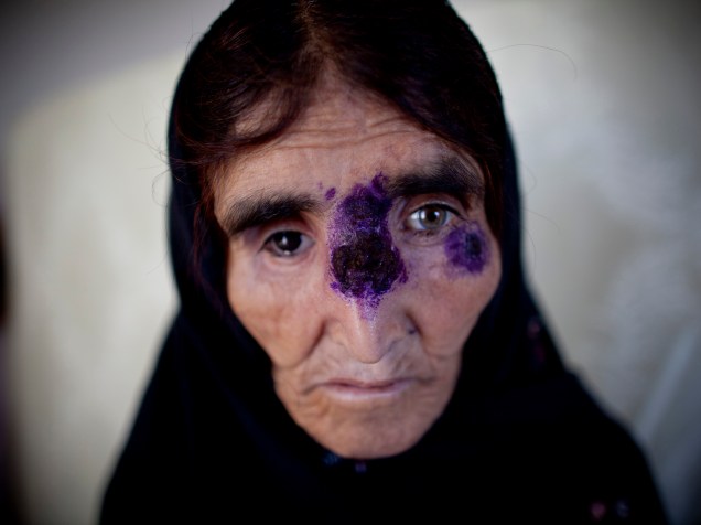 Mulher afegã recebe tratamento para a leishmaniose, doença que causa graves feridas na pele, em um hospital no Afeganistão