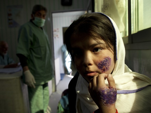 Garota recebe tratamento em uma clínica especializada para o tratamento de leishmaniose, no Afeganistão