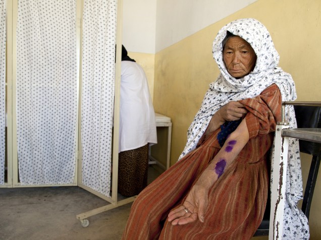Senhora recebe tratamento em uma clínica especializada para o tratamento de leishmaniose, no Afeganistão