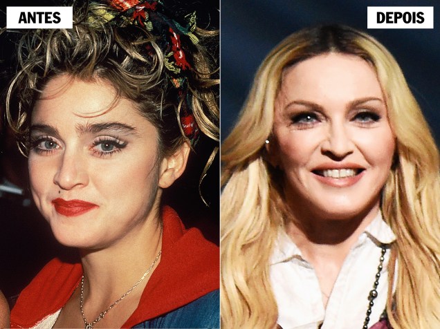 MADONNA - Como ela não poderia jamais ficar para trás, foi a pioneira na bichectomia entre os muito famosos