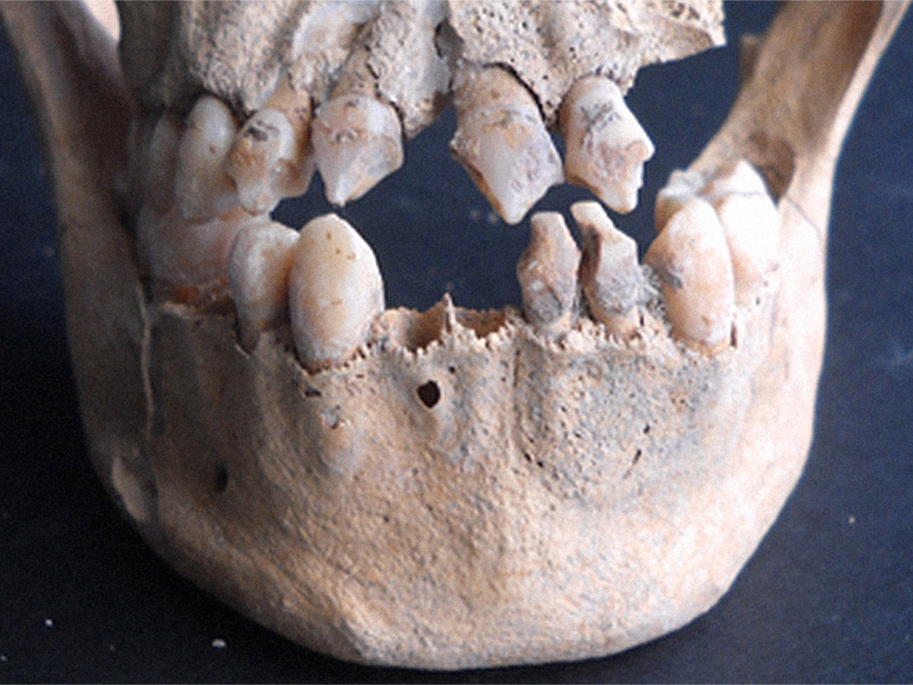 Maxilar e mandíbula de esqueleto do século XVII encontrado na ilha caribenha de St. Martin