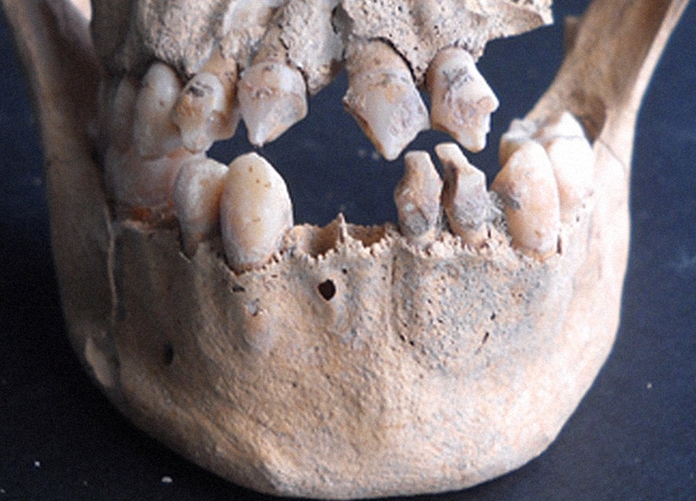 Maxilar e mandíbula de esqueleto do século XVII encontrado na ilha caribenha de St. Martin
