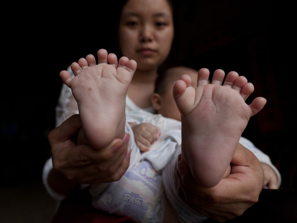 Menino chinês nasceu com 31 dedos das mãos e pés