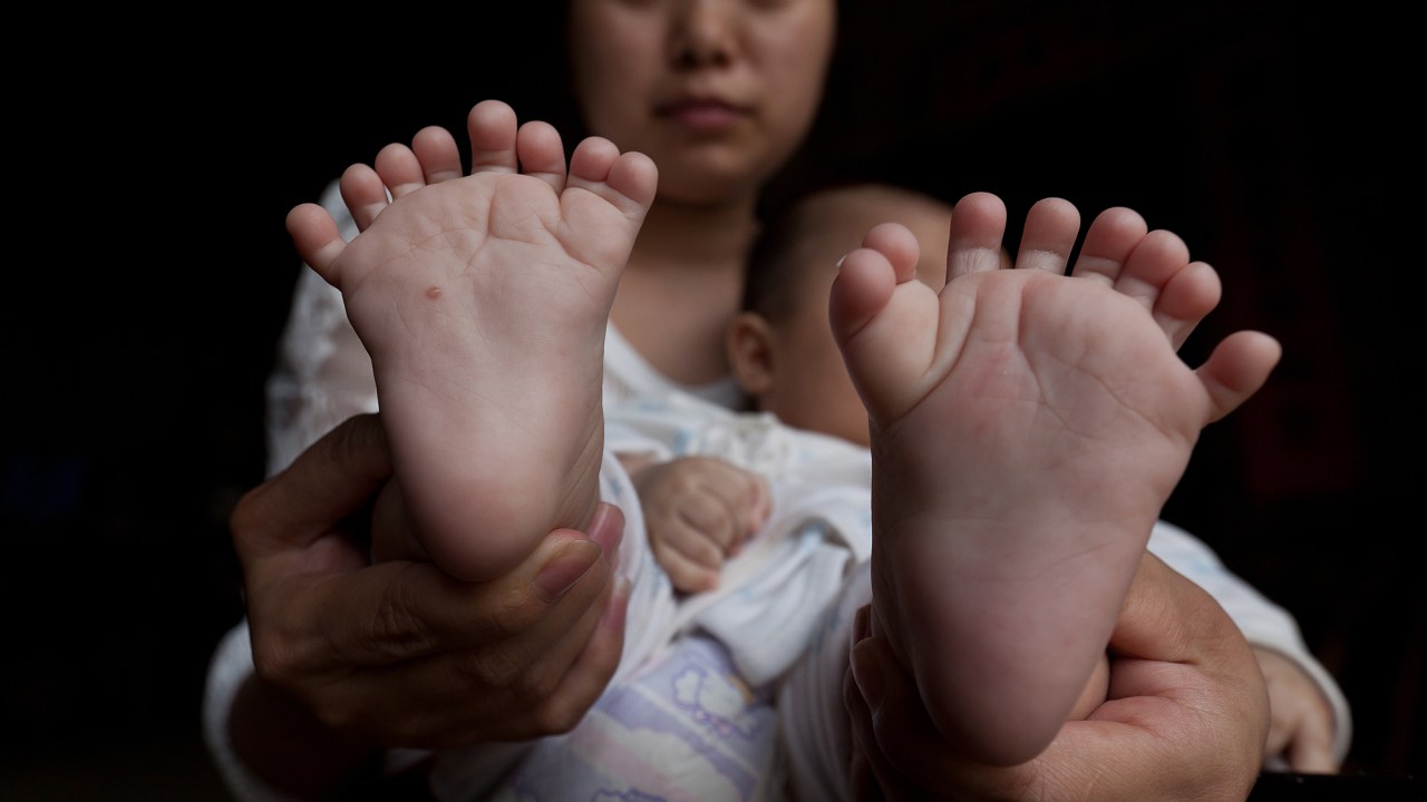 Menino chinês nasceu com 31 dedos das mãos e pés