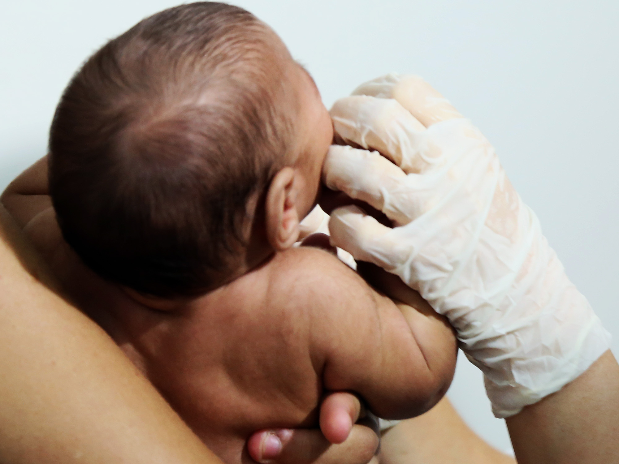 Primeiros pacientes com microcefalia a receber atendimento na Policlínica Lessa de Andrade, no bairro da Madalena, na zona oeste do Recife (PE)