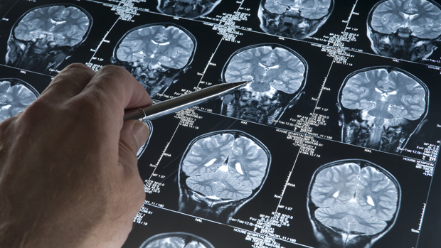 Pesquisadores têm vasto conhecimento sobre as transformações do cérebro pelo Alzheimer, e possuem um entendimento melhor sobre como e quando intervir com remédios