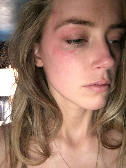 Amber Heard surge com o olho machucado. Agressão teria sido causada por Johnny Depp