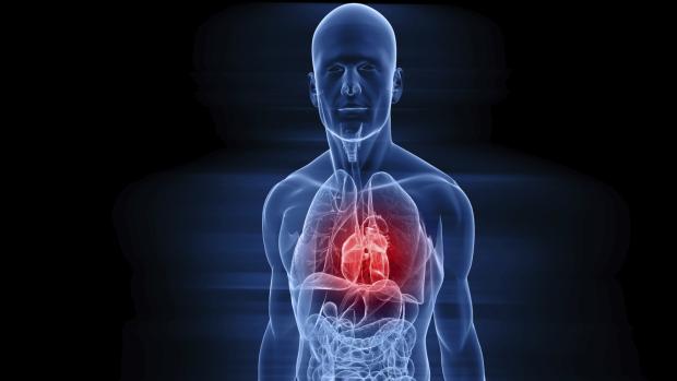 Infarto