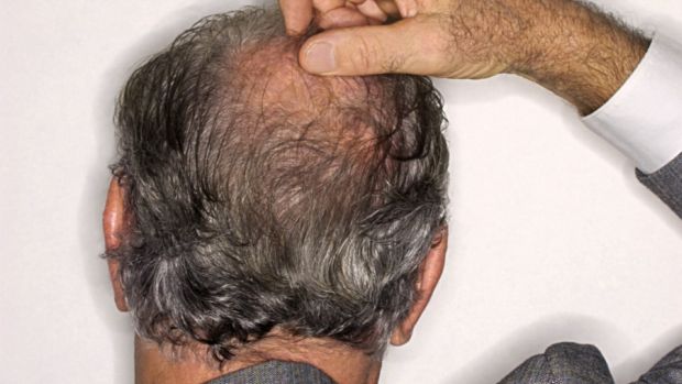 Perda de cabelo no topo da cabeça, formando a chamada 'coroa',pode estar relacionada a um risco maior de doença coronariana, diz estudo