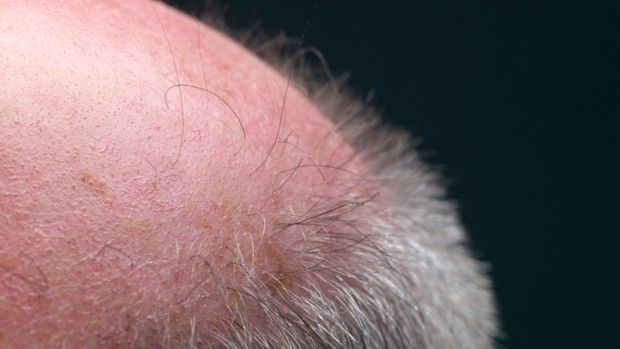 A falta de células progenitoras na região sem cabelo do couro cabeludo pode ser a chave para a cura da calvicie