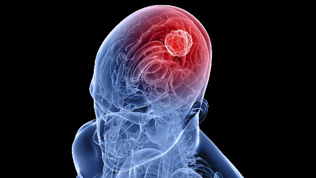 Tratamento: o indirubin, substância derivada da planta índigo, consegue evitar que o tumor se espalhe por todo o cérebro