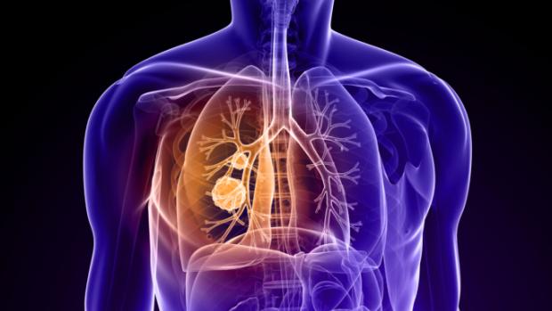 O câncer de pulmão é considerado um dos mais letais, uma vez que sua detecção é feita em estágios tardios da doenç