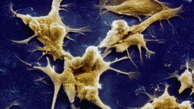 Nanotecnologia: composto poderá identificar células do câncer no estágio inicial da doença