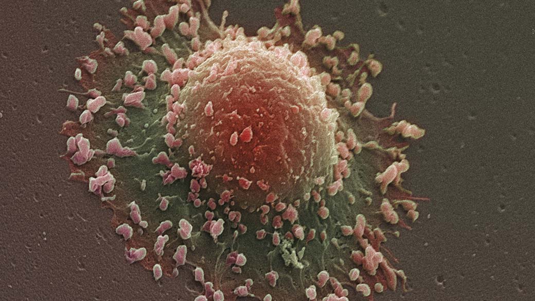 Células de câncer no pulmão. A incidência de câncer no mundo cresceu 20% na última década