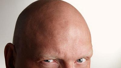 Transplantes capilares viram grande negócio, mas tratamento tem riscos