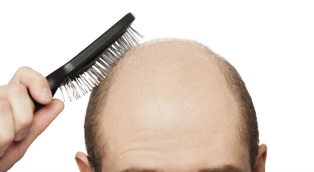 Calvície: o problema atinge cerca de 85% dos homens acima dos 65 anos
