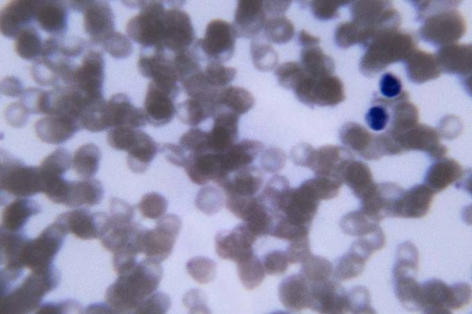 celula-anemia-falciforme-original.jpeg