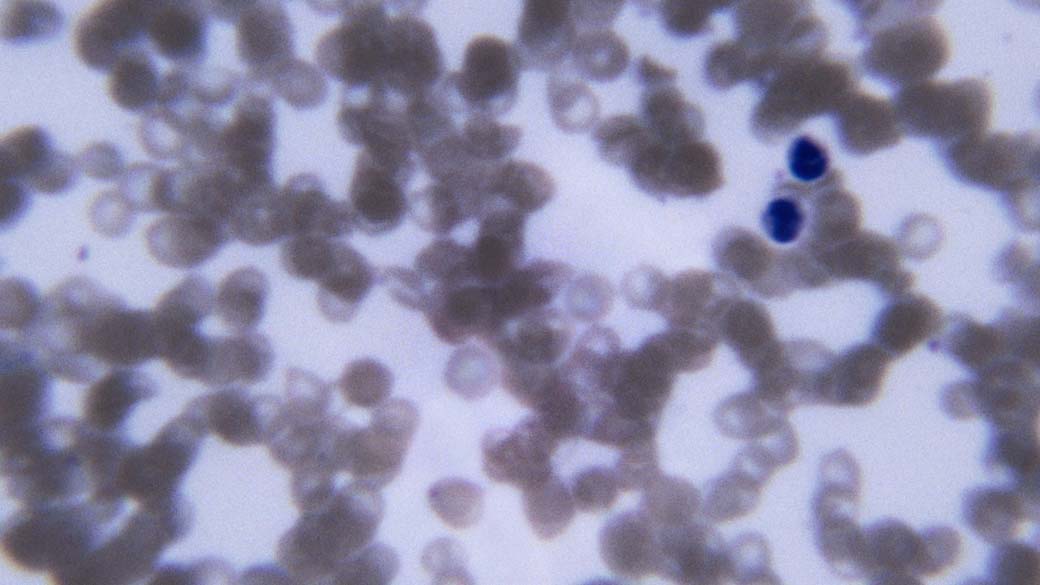 Células com anemia falciforme