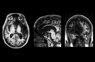Cérebro de um paciente de 57 anos que foi estudado por pesquisadores. Cientistas concluíram que a autoconsciência não se limita a uma região do cérebro