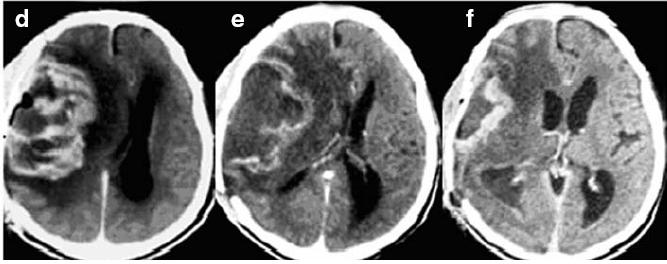 Na figura D, a imagem de uma tomografia computadorizada realizada antes do paciente receber o tratamento com álcool perílico. Na imagem E e F, o resultado após três meses e cinco meses de tratamento com a substância quimioterápica, respectivamente