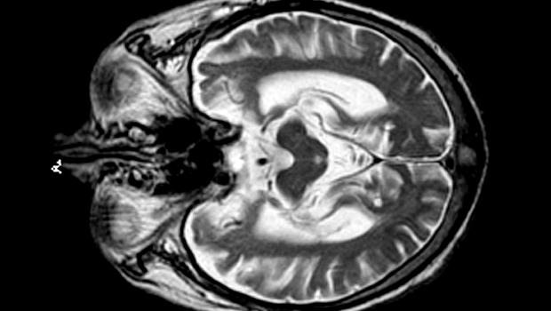 A doença de Alzheimer acontece quando placas da proteína amiloide se depositam no cérebro