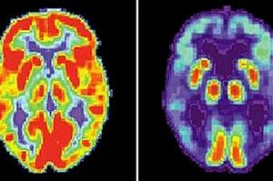 Imagem do cérebro de uma pessoa sadia (a esq.) e um cérebro de alguém que sofre de Alzheimer (dir.)
