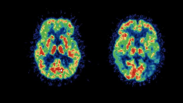 Cérebro e Alzheimer