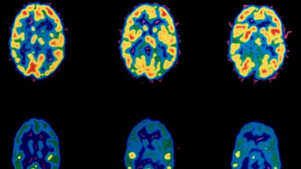 Imagens mostram atividade cerebral durante o uso de cocaína
