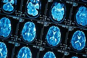 cerebros-epilepsia.jpg