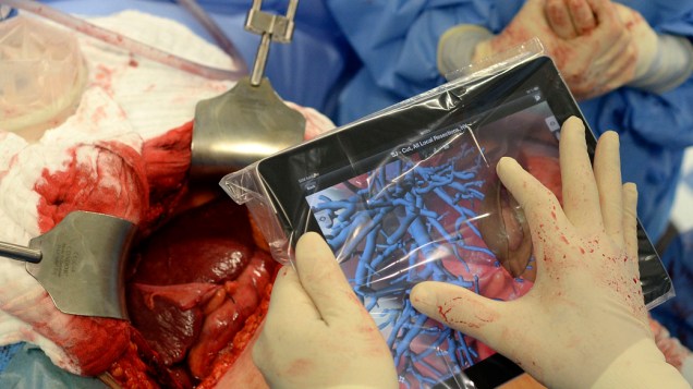 O aplicativo mostra, em tempo real, a localização de vasos sanguíneos e tumores no fígado