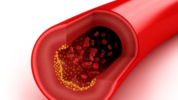 O colesterol ruim (LDL) em excesso está associado ao surgimento de doenças cardiovasculares